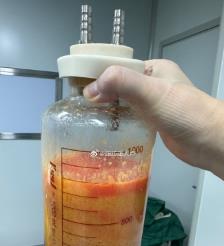 西安水动力吸脂手术要做多久？